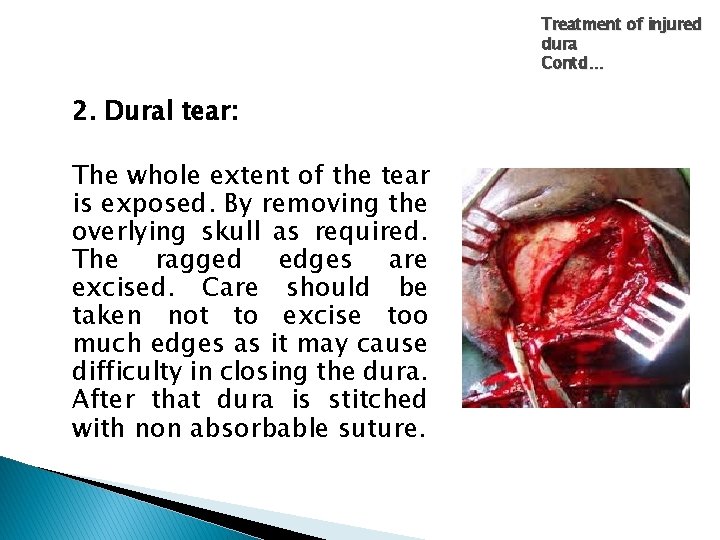 Treatment of injured dura Contd… 2. Dural tear: The whole extent of the tear