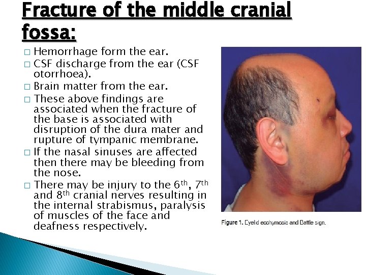 Fracture of the middle cranial fossa: Hemorrhage form the ear. � CSF discharge from