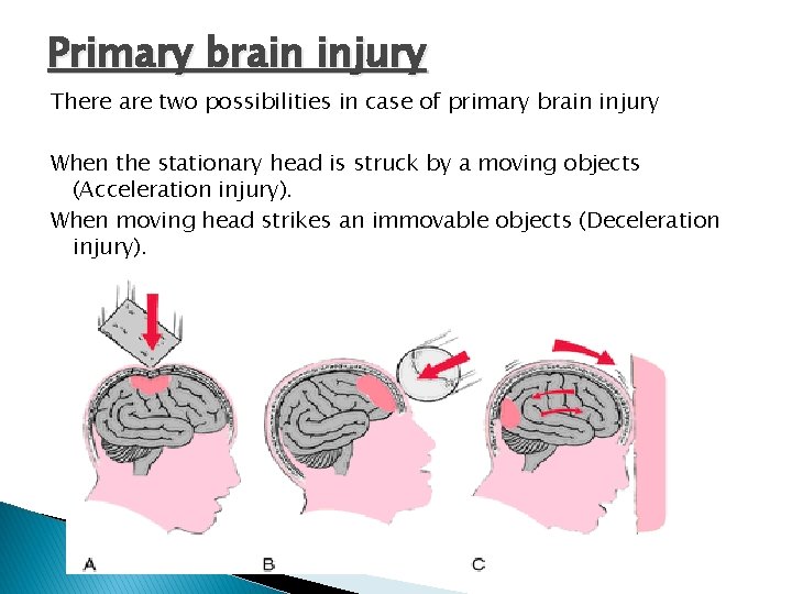 Primary brain injury There are two possibilities in case of primary brain injury When