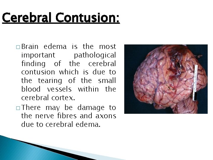 Cerebral Contusion: � Brain edema is the most important pathological finding of the cerebral