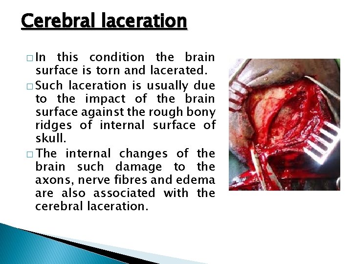 Cerebral laceration � In this condition the brain surface is torn and lacerated. �