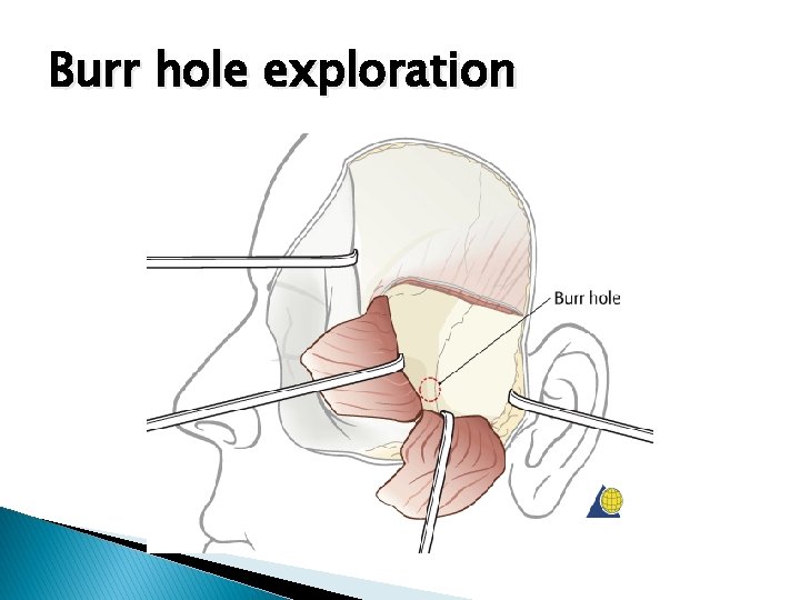 Burr hole exploration 