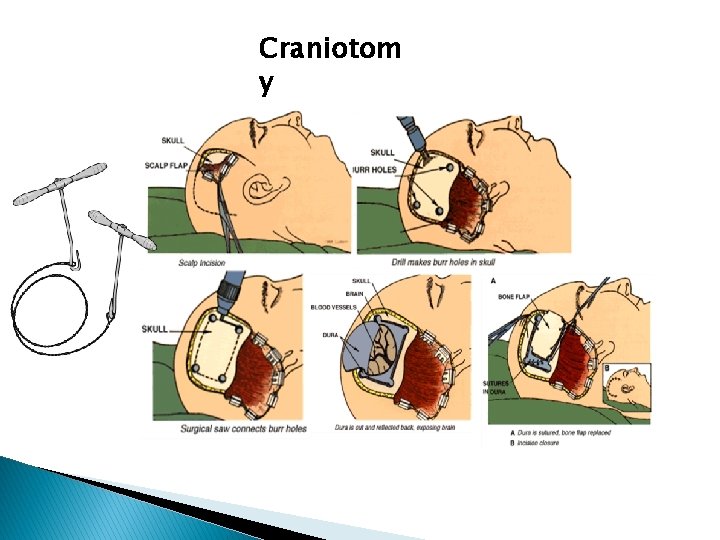 Craniotom y 