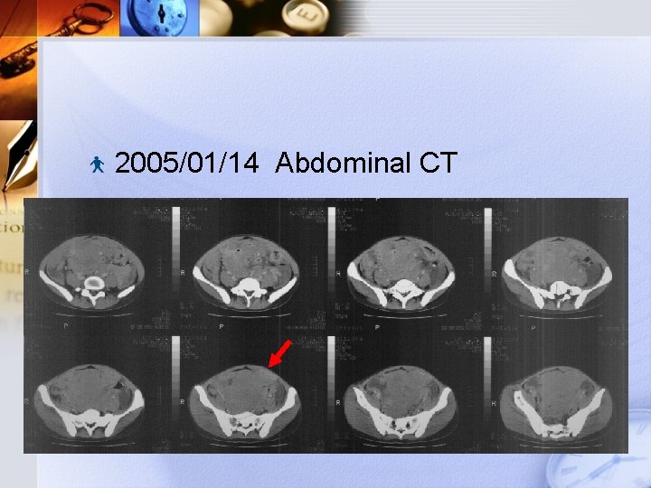 2005/01/14 Abdominal CT 