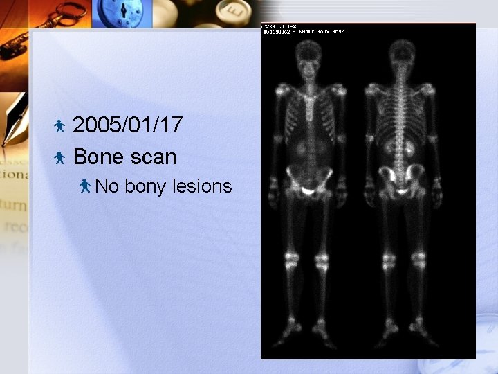 2005/01/17 Bone scan No bony lesions 