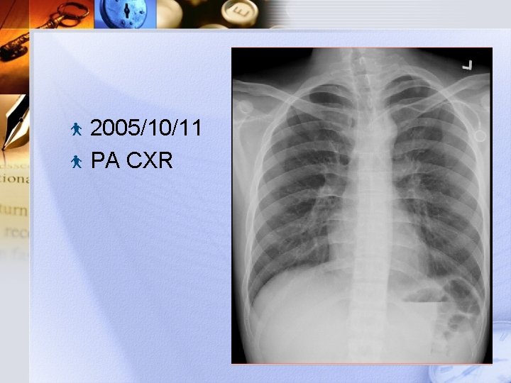 2005/10/11 PA CXR 