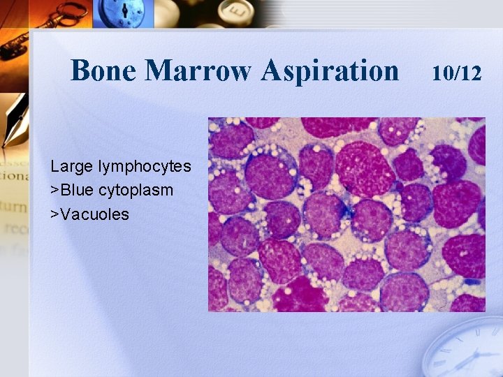 Bone Marrow Aspiration Large lymphocytes >Blue cytoplasm >Vacuoles 10/12 
