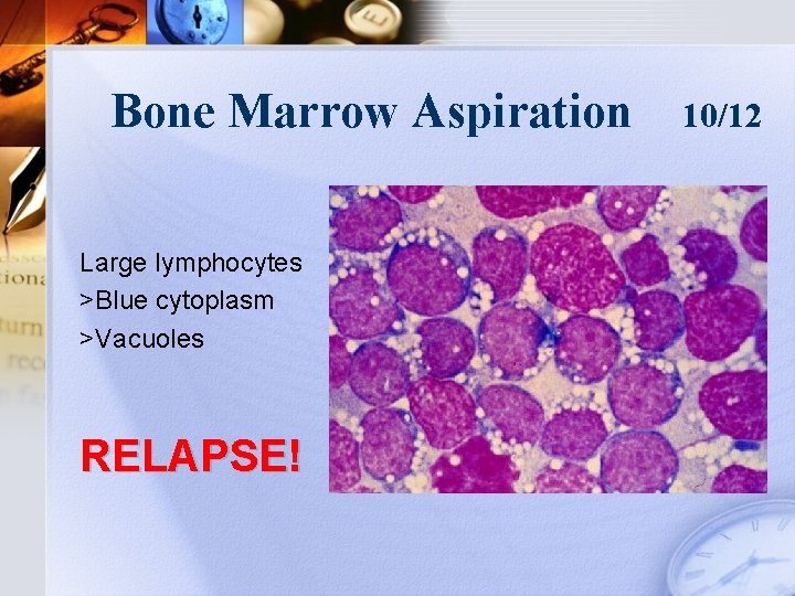 Bone Marrow Aspiration Large lymphocytes >Blue cytoplasm >Vacuoles RELAPSE! 10/12 