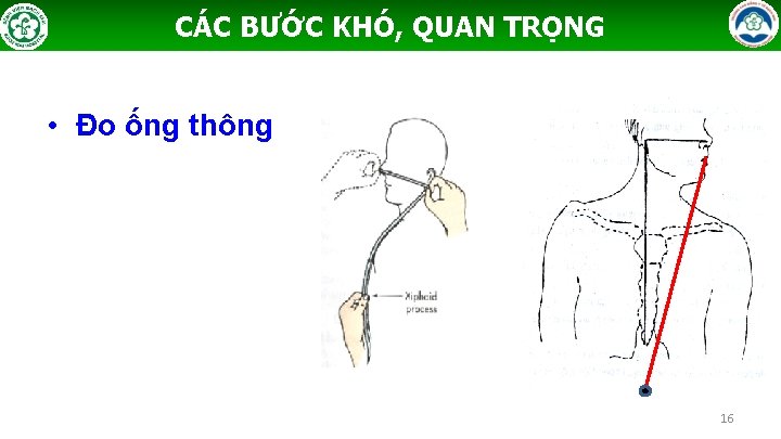 CÁC BƯỚC KHÓ, QUAN TRỌNG • Đo ống thông 16 