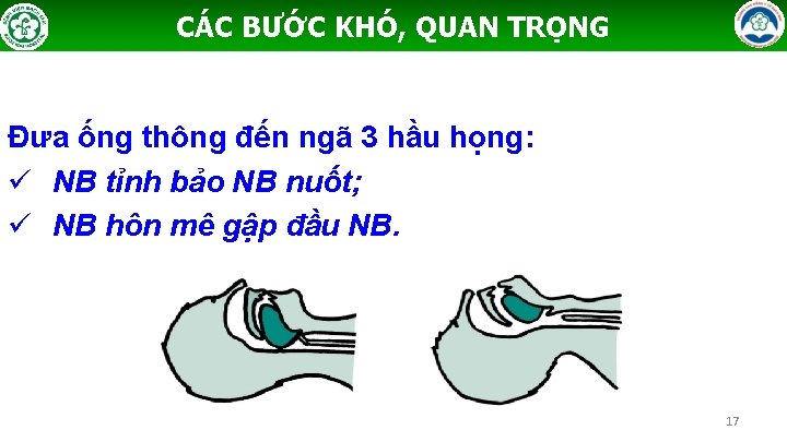 CÁC BƯỚC KHÓ, QUAN TRỌNG Đưa ống thông đến ngã 3 hầu họng: ü