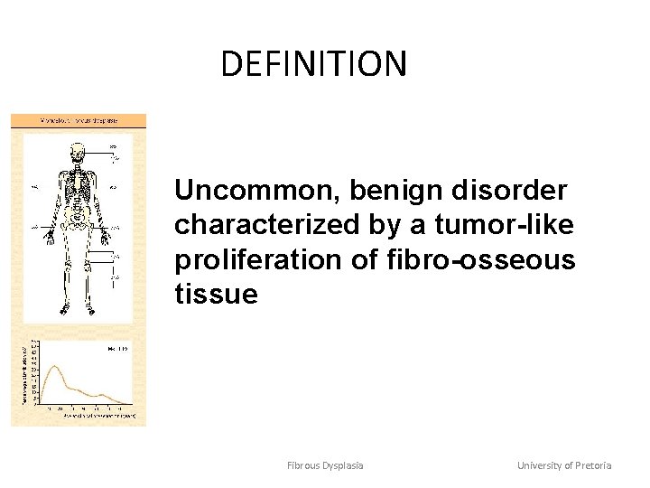 DEFINITION Uncommon, benign disorder characterized by a tumor-like proliferation of fibro-osseous tissue Fibrous Dysplasia