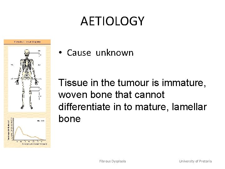 AETIOLOGY • Cause unknown Tissue in the tumour is immature, woven bone that cannot
