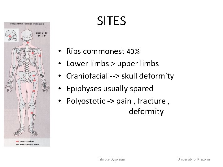 SITES • • • Ribs commonest 40% Lower limbs > upper limbs Craniofacial -->