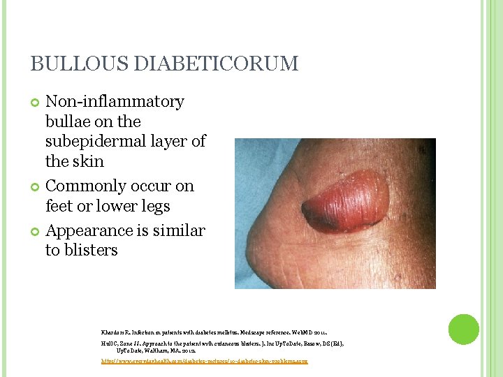 BULLOUS DIABETICORUM Non-inflammatory bullae on the subepidermal layer of the skin Commonly occur on