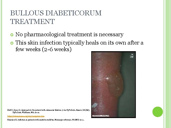 BULLOUS DIABETICORUM TREATMENT No pharmacological treatment is necessary This skin infection typically heals on