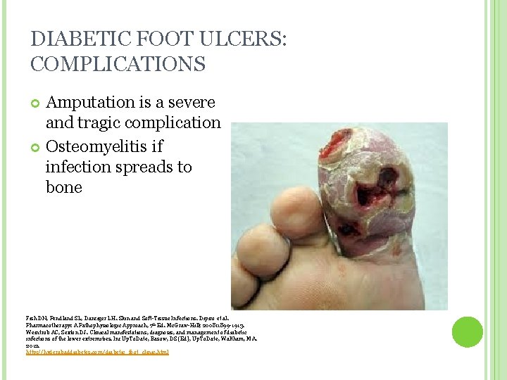 DIABETIC FOOT ULCERS: COMPLICATIONS Amputation is a severe and tragic complication Osteomyelitis if infection