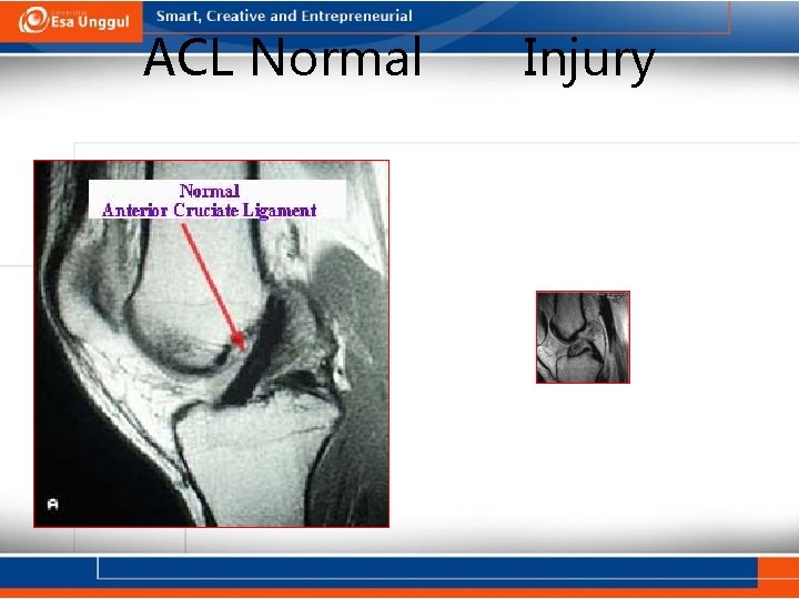 ACL Normal Injury 