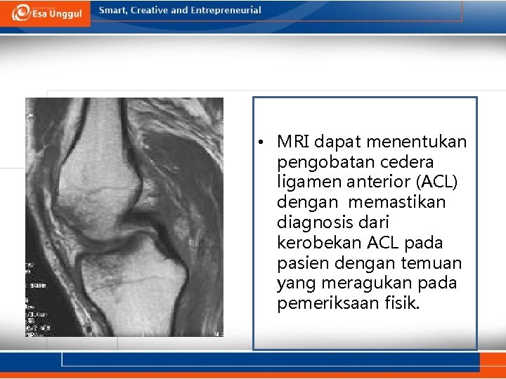  • MRI dapat menentukan pengobatan cedera ligamen anterior (ACL) dengan memastikan diagnosis dari