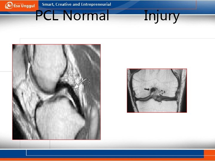 PCL Normal Injury 