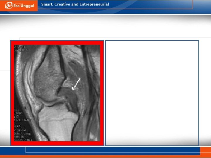  • Kerobekan Posterior Cruciatum Ligamen (PCL) • MRI menunjukkan / memastikan kerobekan PCL