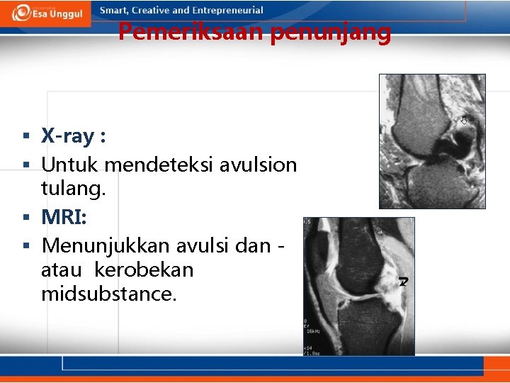 Pemeriksaan penunjang X-ray : Untuk mendeteksi avulsion tulang. MRI: Menunjukkan avulsi dan atau kerobekan