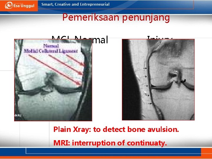 Pemeriksaan penunjang MCL Normal Injury Plain Xray: to detect bone avulsion. MRI: interruption of