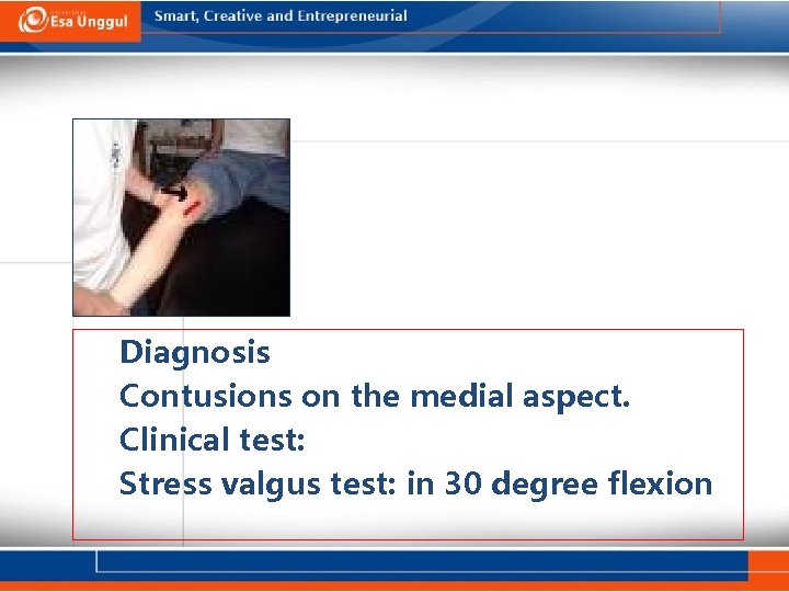 Diagnosis Contusions on the medial aspect. Clinical test: Stress valgus test: in 30 degree