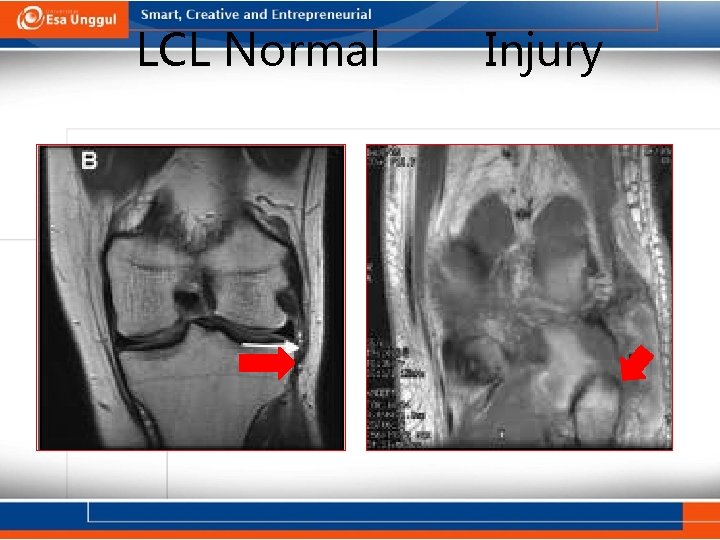 LCL Normal Injury 