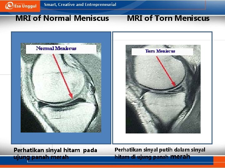 MRI of Normal Meniscus Perhatikan sinyal hitam pada ujung panah merah MRI of Torn
