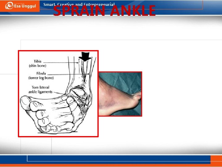 SPRAIN ANKLE 