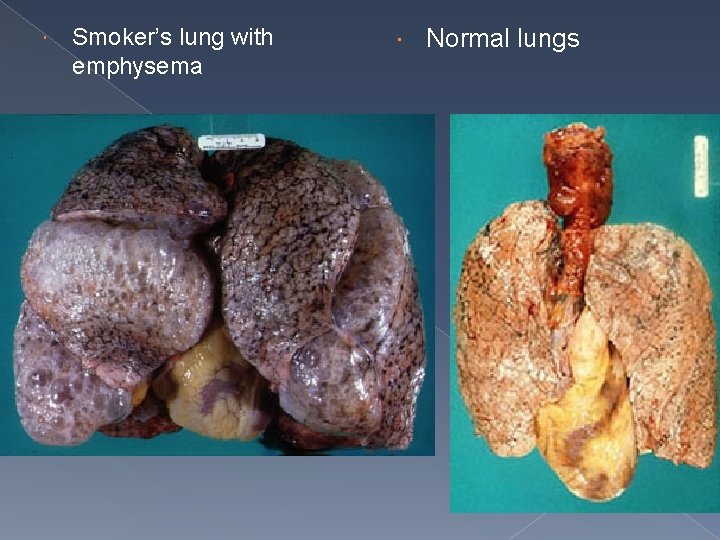  Smoker’s lung with emphysema Normal lungs 