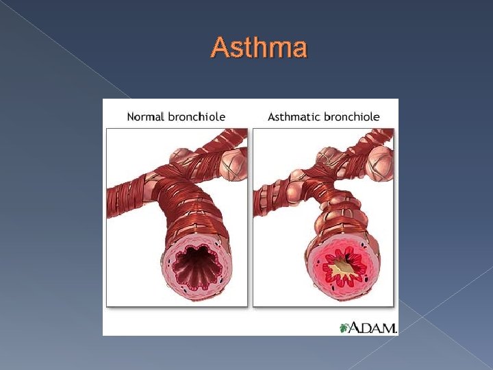 Asthma 