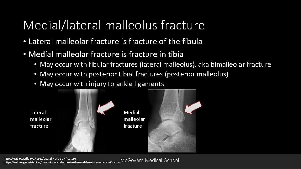 Medial/lateral malleolus fracture • Lateral malleolar fracture is fracture of the fibula • Medial