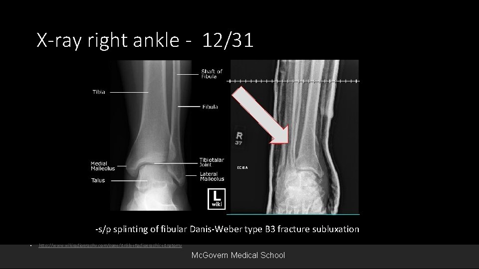 X-ray right ankle - 12/31 -s/p splinting of fibular Danis-Weber type B 3 fracture