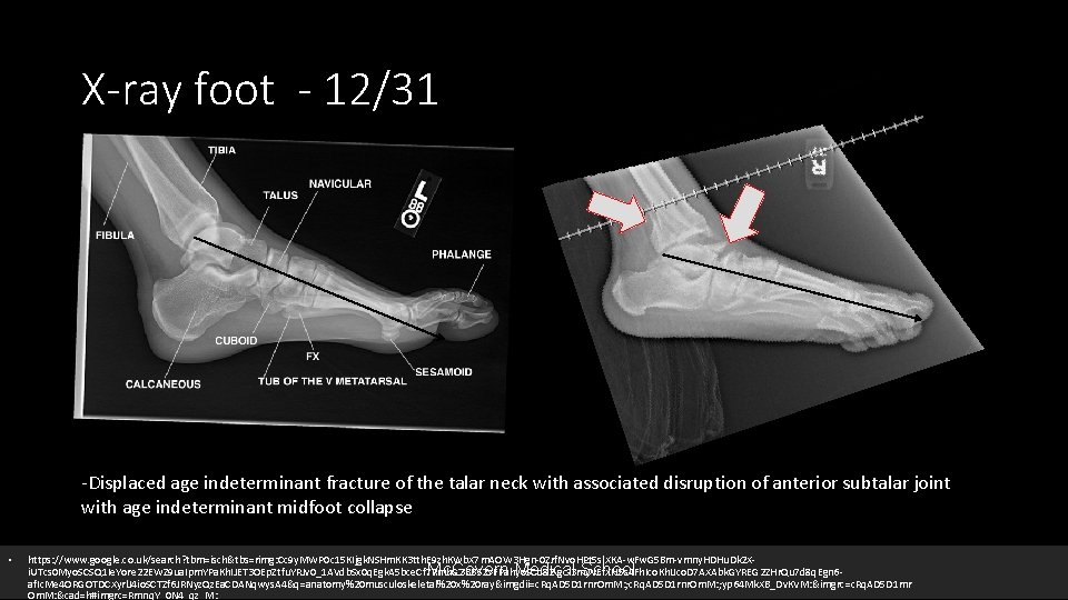 X-ray foot - 12/31 -Displaced age indeterminant fracture of the talar neck with associated
