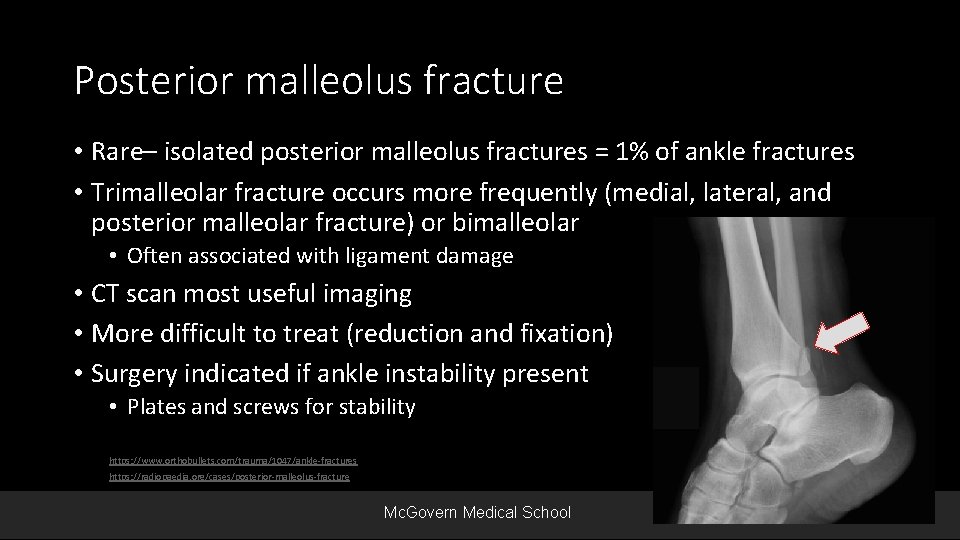 Posterior malleolus fracture • Rare– isolated posterior malleolus fractures = 1% of ankle fractures