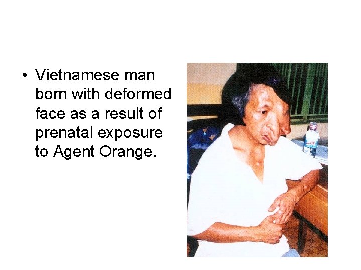  • Vietnamese man born with deformed face as a result of prenatal exposure