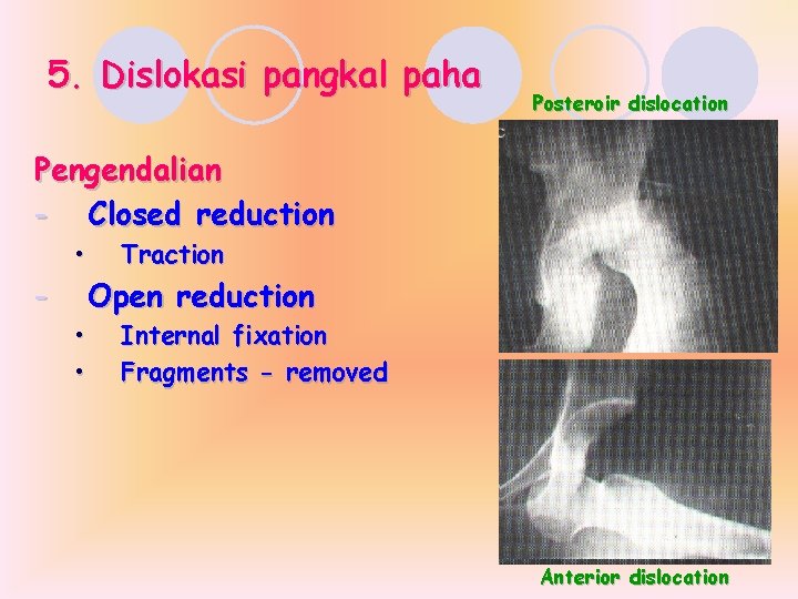 5. Dislokasi pangkal paha Posteroir dislocation Pengendalian - Closed reduction - • • •