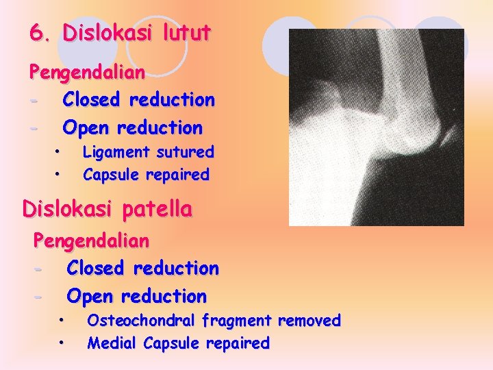 6. Dislokasi lutut Pengendalian - Closed reduction - Open reduction • • Ligament sutured