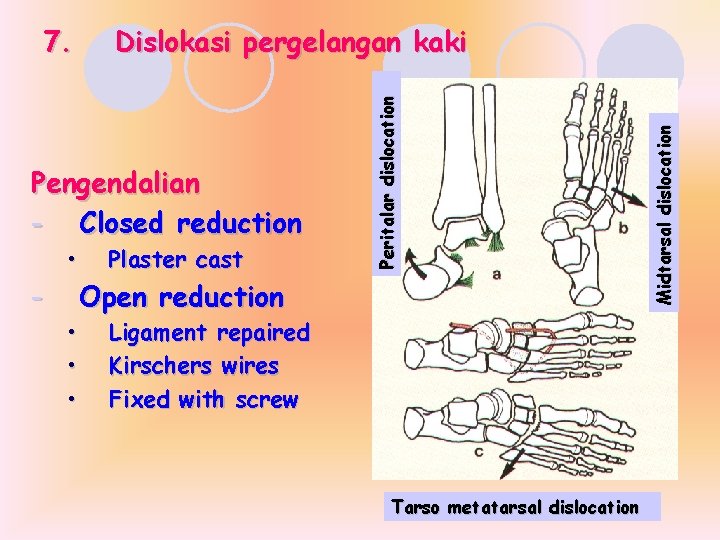 Pengendalian - Closed reduction - • • Plaster cast Open reduction Ligament repaired Kirschers