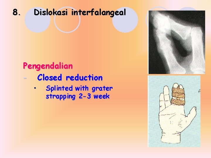 8. Dislokasi interfalangeal Pengendalian - Closed reduction • Splinted with grater strapping 2 -3