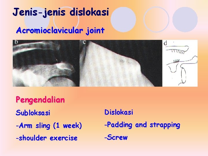 Jenis-jenis dislokasi Acromioclavicular joint Pengendalian Subloksasi Dislokasi -Arm sling (1 week) -Padding and strapping