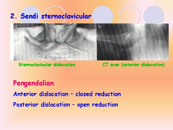 2. Sendi sternoclavicular Sternoclavicular dislocation CT scan (anterior dislocation) Pengendalian Anterior dislocation – closed