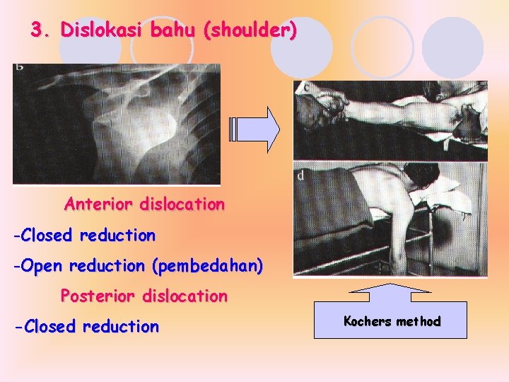 3. Dislokasi bahu (shoulder) Anterior dislocation -Closed reduction -Open reduction (pembedahan) Posterior dislocation -Closed