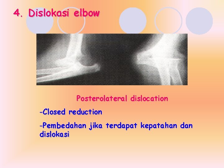 4. Dislokasi elbow Posterolateral dislocation -Closed reduction -Pembedahan jika terdapat kepatahan dislokasi 