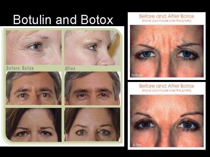 Botulin and Botox 