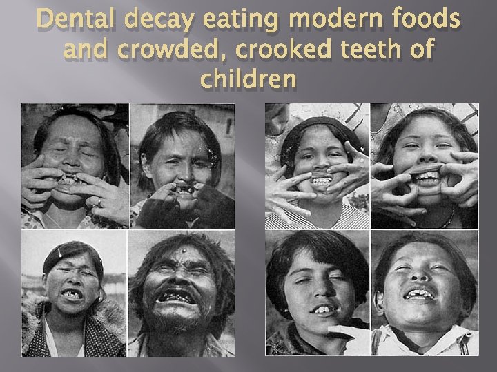 Dental decay eating modern foods and crowded, crooked teeth of children 