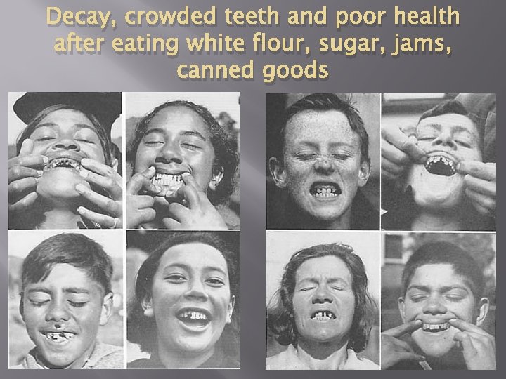 Decay, crowded teeth and poor health after eating white flour, sugar, jams, canned goods