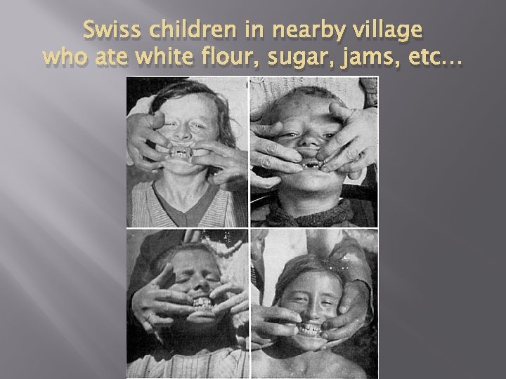 Swiss children in nearby village who ate white flour, sugar, jams, etc… 