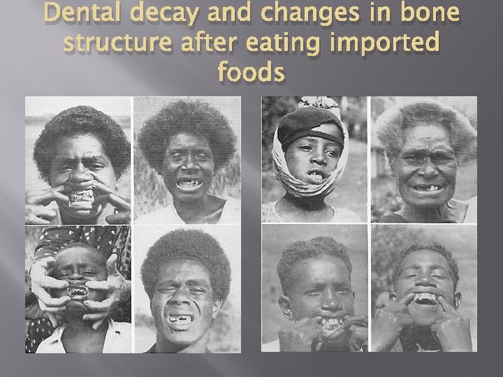 Dental decay and changes in bone structure after eating imported foods 